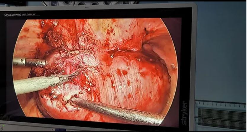 Laparoscopic hysterectomy surgery view on medical monitor showing uterus removal with surgical instruments