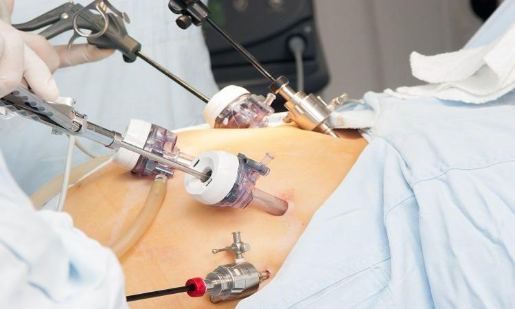 laparoscopy surgury